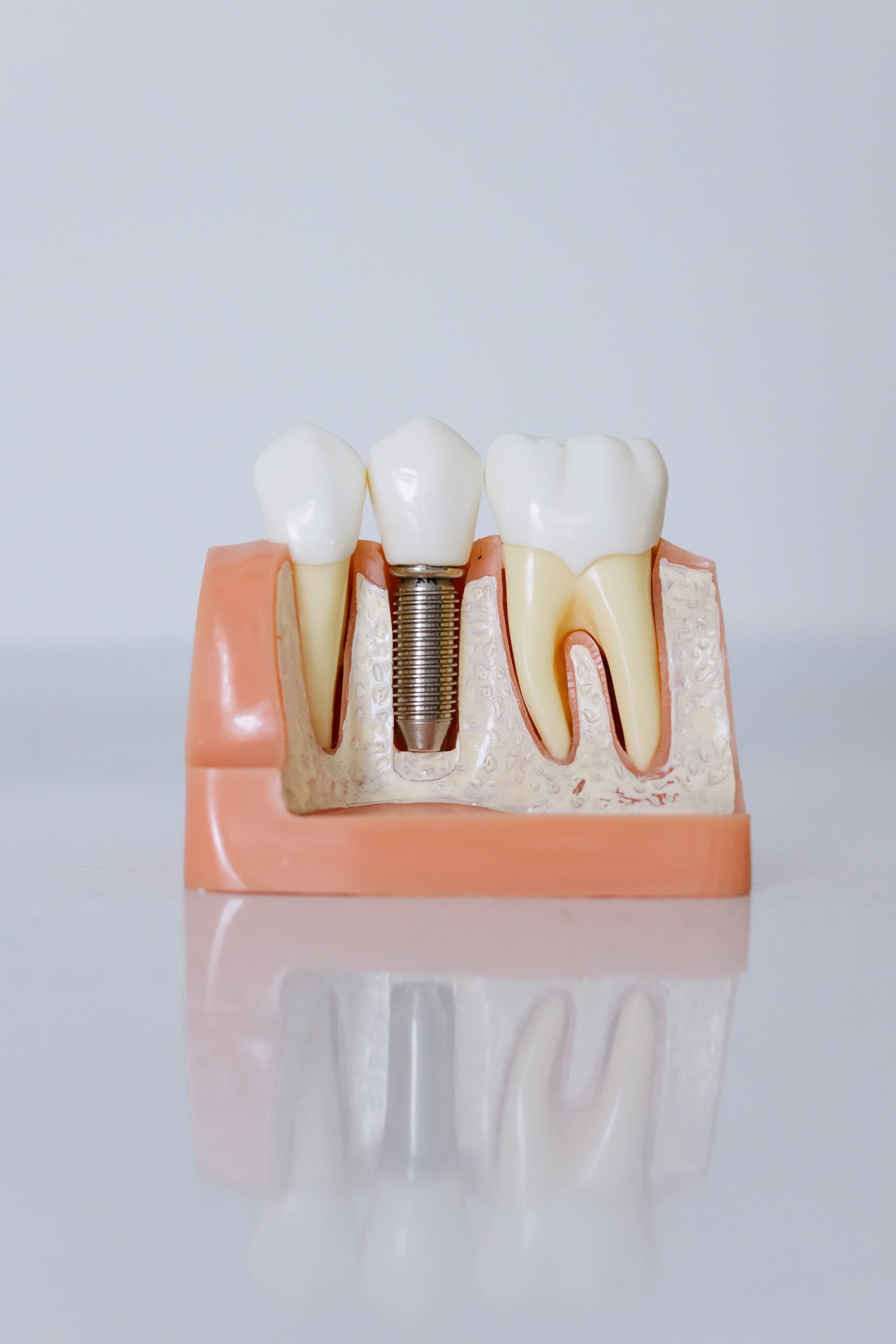 Unveiling Dental Implant Secrets: What You Need to Know